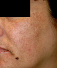 melasma cause before and after photos