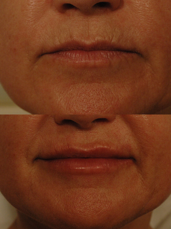 mouth and lip shaping