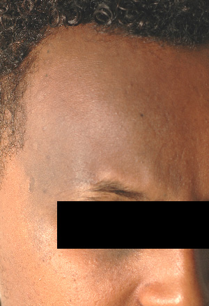 nevus of ota