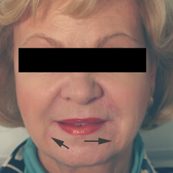 oral commissures chin rejuvenation restylane los angeles before and after pictures