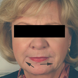 oral commissures chin rejuvenation restylane los angeles before and after pictures