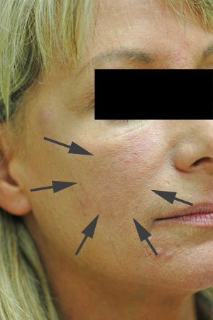 los angeles cheek augmentation with perlane before and after pictures