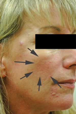 los angeles cheek augmentation with perlane before and after pictures