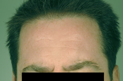 laser age spot removal after picture