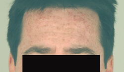 laser age spot removal before picture