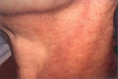 sun damage neck chest laser treatment los angeles before and after pictures