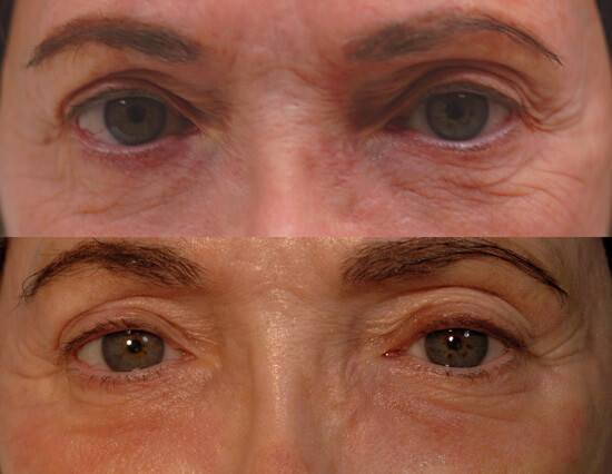 Fractional Laser Resurfacing for Eye Wrinkles