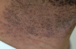 Laser Hair Removal for Razor Bumps