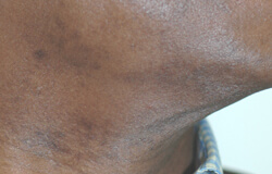 razor bumps laser hair removal before and after pictures