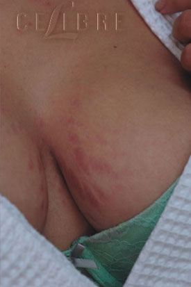 Red Stretch Marks After Photo