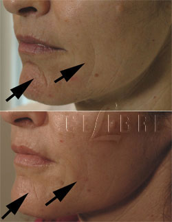 restylane for shaping the chin