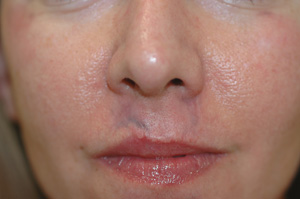 road rash scars before laser treatment
