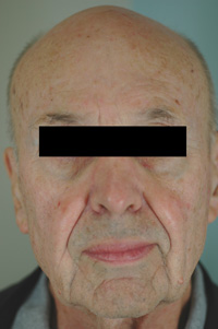 Rosacea Treatment los angeles before and after pictures