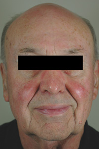 rosacea laser treatments los angeles before and after pictures