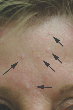 sebaceous hyplerplasia treatment before and after pictures