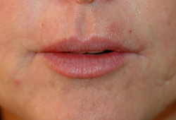 restylane los angeles for smokers lines before and after pictures