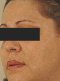 long beach california age spot removal before and after pictures