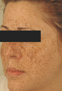 long beach california age spot removal before and after pictures