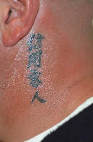 Skin Fade  The Laser Tattoo Removal  Skin Clinic  Camberley