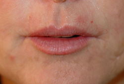 smokers lines botox restylane after