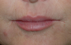 smokers lines botox restylane before