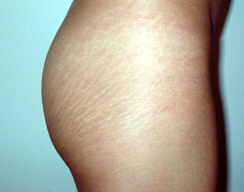 Red vs. White Stretch Marks: 5 Things You Need to Know