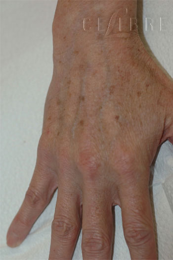 hand rejuvenation before photo