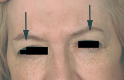 Botox Brow Lift Before Pictures