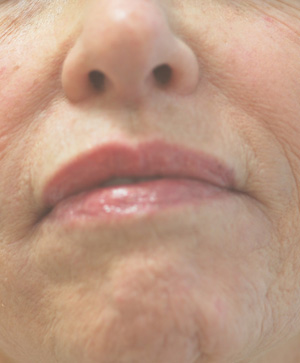 Restylane for chin symmetry Before Pictures