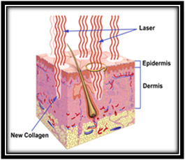 Fractional Laser Resurfacing