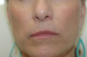 Los Angeles laser treatments and injections before and after Pictures