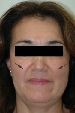 Los Angeles restylane injections before and after Pictures