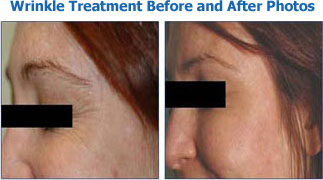 Wrinkle Treatment Before and After Photos