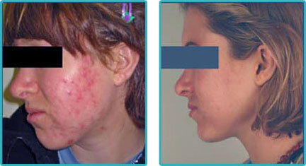 Acne Laser Treatment Before After