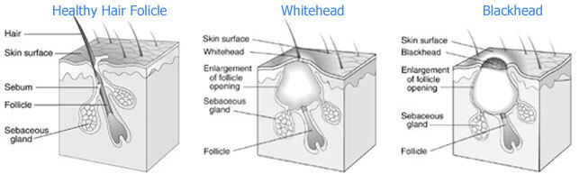 causes of acne