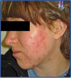 acne before photo