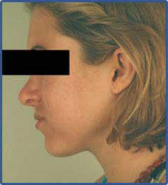 after laser acne treatment photo