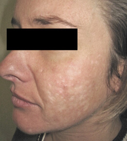 ablative laser resurfacing los angeles before and after pictures