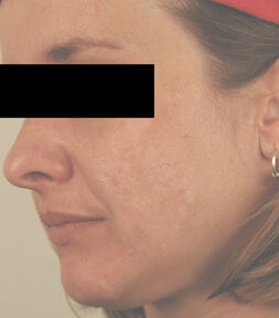 ablative laser resurfacing los angeles before and after pictures