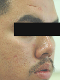 ablative laser resurfacing los angeles before and after pictures