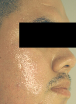 ablative laser resurfacing los angeles before and after pictures