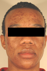 ablative laser resurfacing los angeles before and after pictures