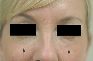 Restylane tear trough After Picture