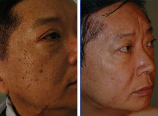 Laser Treatments for Asian Skin - Orange County and Torrance