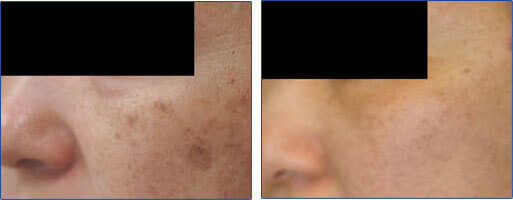 Laser Removal of Age Spots on Asian Skin