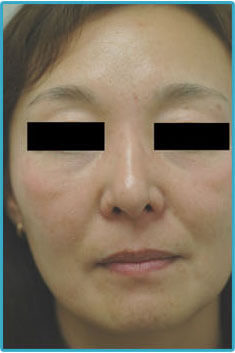 melasma treatments