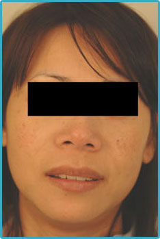 laser age spot removal treatments for Asians