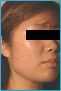 laser acne removal