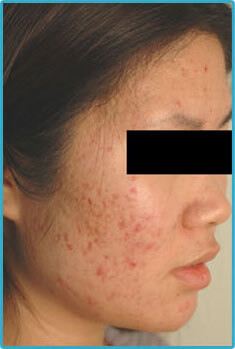 Acne Laser Treaments for Asian Skin