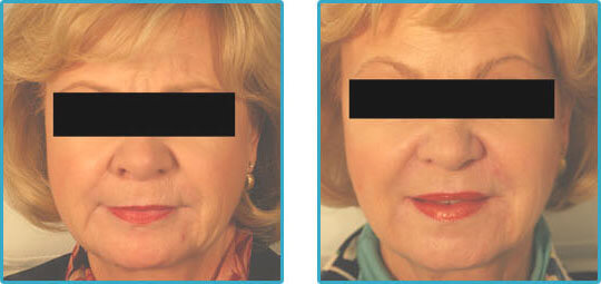 restylane injections chin lines before and after photos